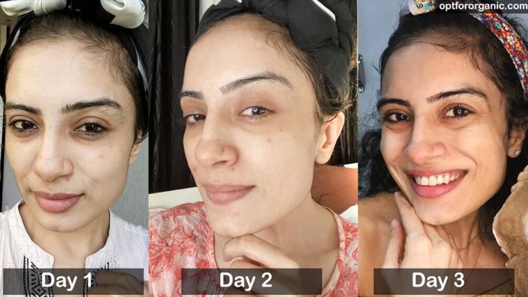 This Soil Face Mask Will Remove Pimples In 3 Days – Guaranteed Results
